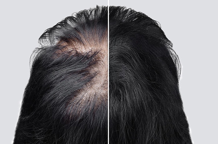 Stress Hair Loss in Women | Innovative Hair Solutions