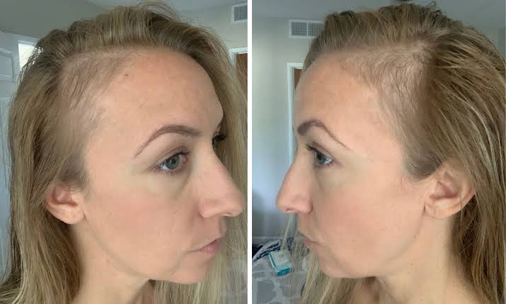 Postpartum Hair Loss Solutions | Innovative Hair Solutions